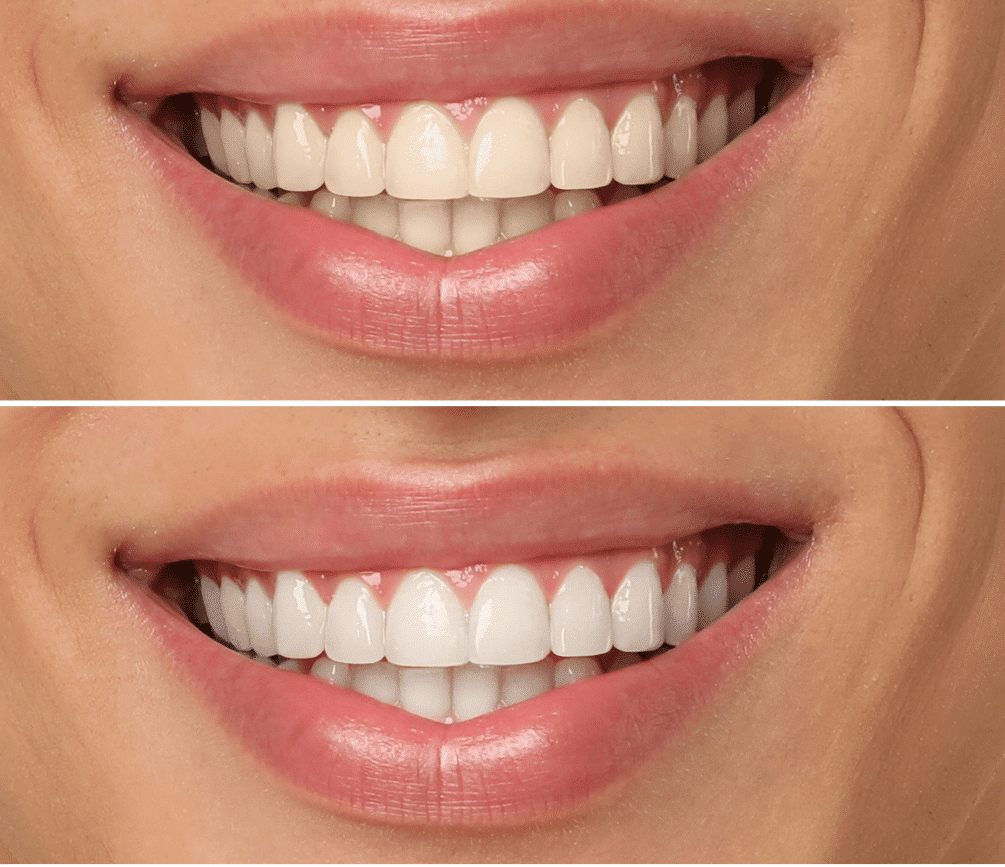 A before-and-after comparison of a patient's smile, showing the transition from yellowed teeth to a bright, white appearance after professional treatment.