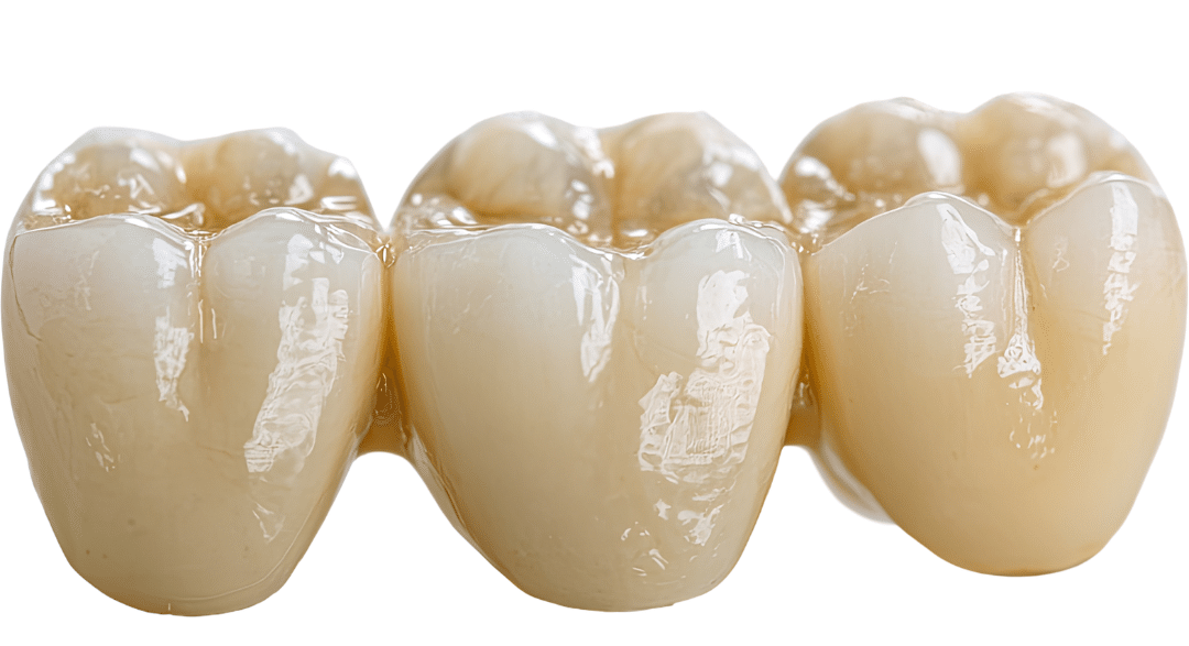 A three-unit porcelain dental bridge designed to replace a missing tooth and blend with natural teeth.