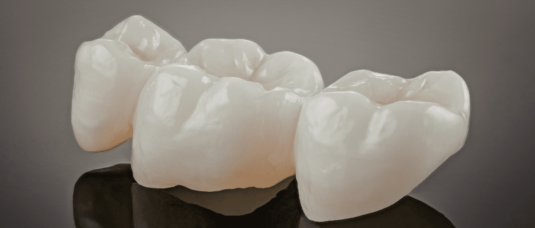 A set of three porcelain dental crowns or a bridge, showcasing their natural, tooth-colored appearance on a dark background.
