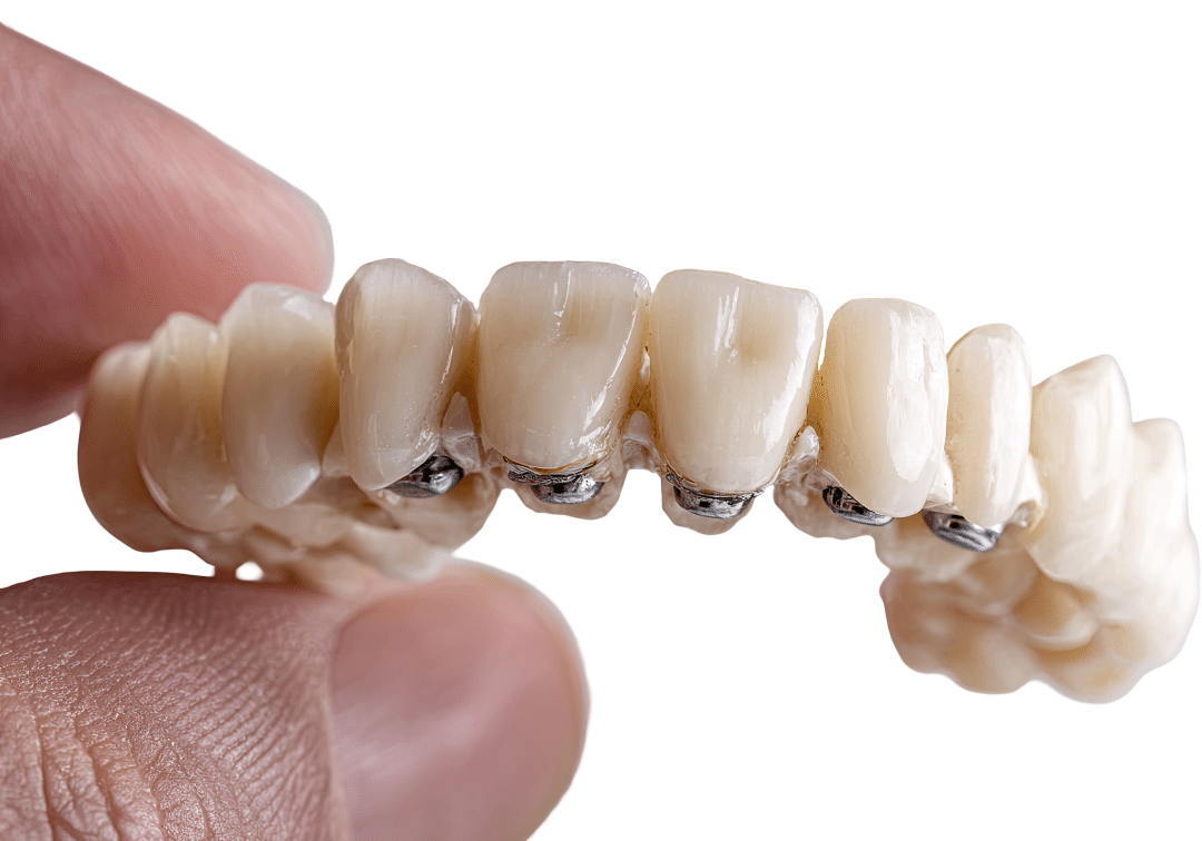 A close-up of a high-quality multi-unit dental bridge held by a professional, showing the detailed porcelain crowns and underlying structure.