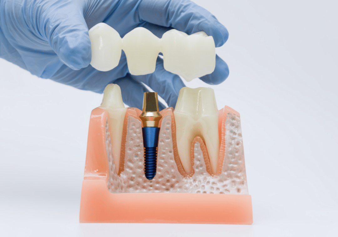 A dentist’s gloved hand placing a dental bridge/crown restoration onto a model of teeth and an implant in a professional setting.