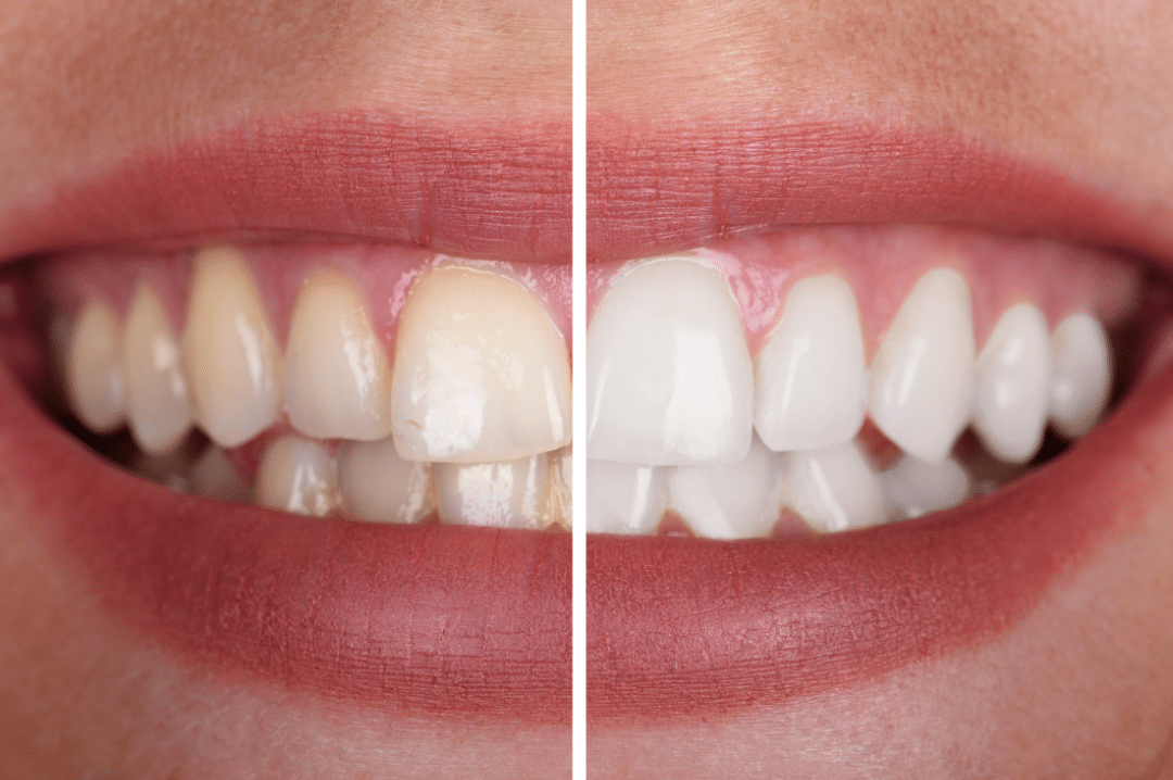 A side-by-side comparison showing a smile before and after a makeover, demonstrating improved tooth shade, alignment, and overall health.