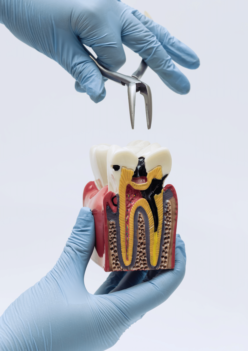 A dental professional in blue gloves using a medical tool to demonstrate a tooth extraction on an anatomical model showing severe decay and internal pulp.