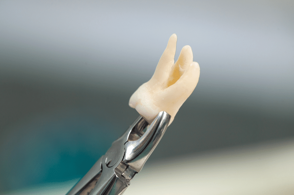 A close-up of a surgical dental tool holding a natural extracted wisdom tooth with three distinct roots.