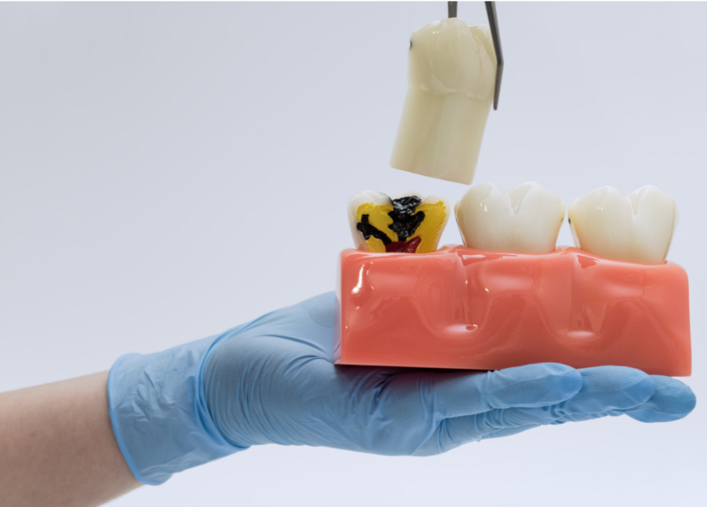A dental professional in blue gloves using a tool to demonstrate the removal of a wisdom tooth from an anatomical gum model showing decay.