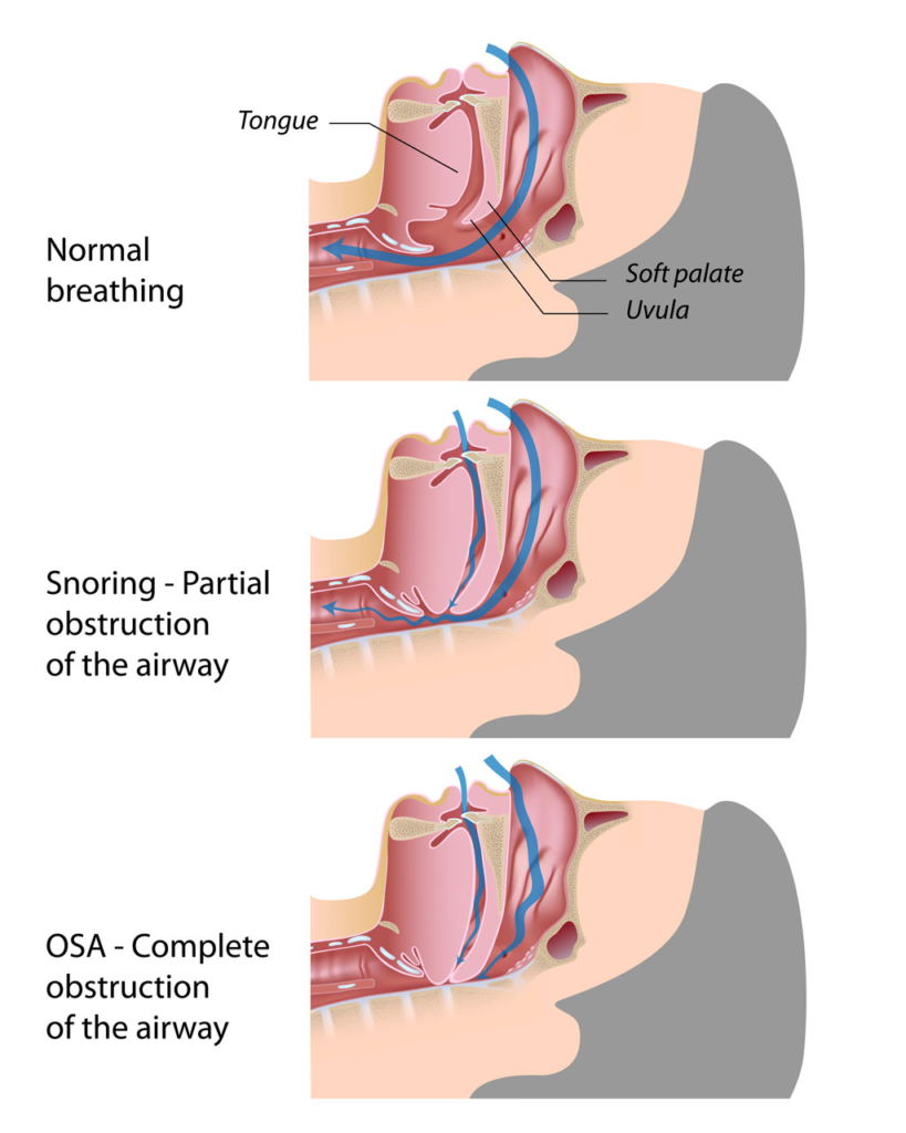 types of sleep apnea diagram